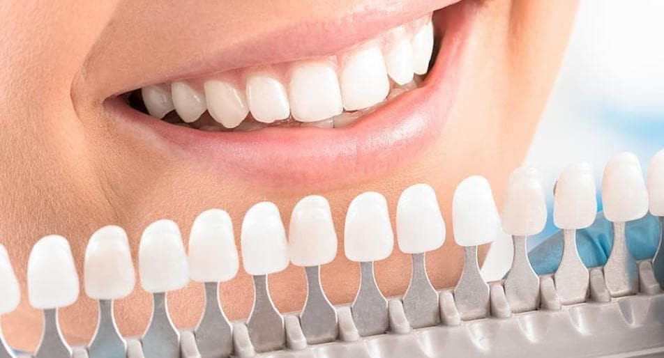 tipos de carillas dentales