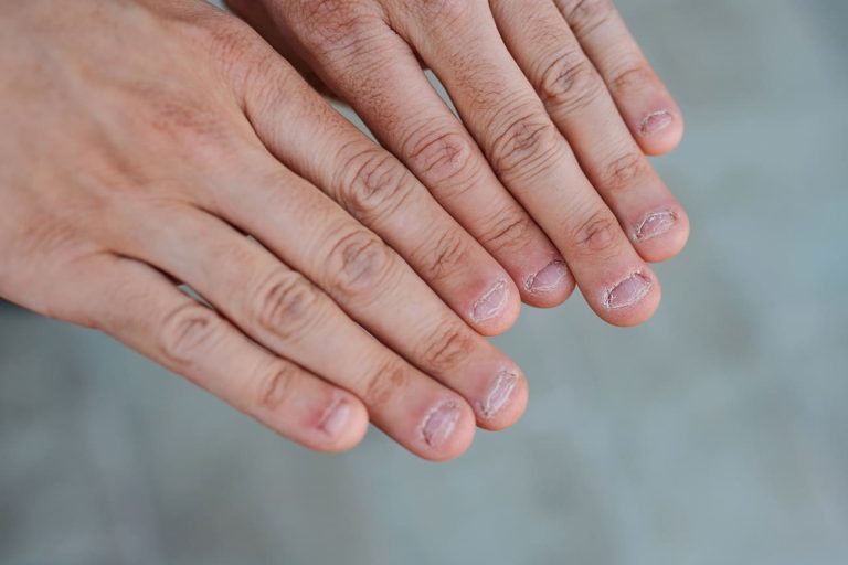 Onicofagia | Clínica Dental Álvarez Nóvoa