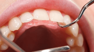 Paladar inflamado | Clínica Dental Álvarez Nóvoa