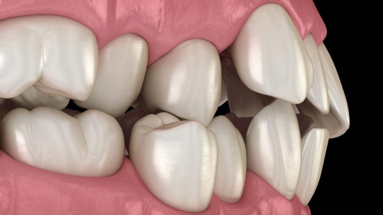 apiñamiento dental | Clínica Dental Álvarez Nóvoa