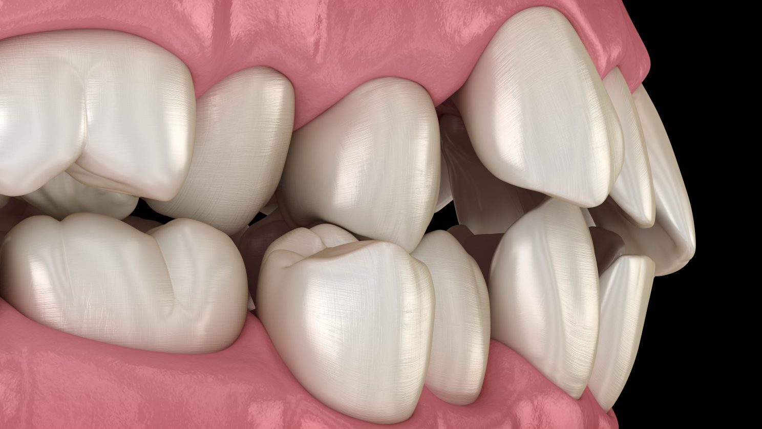 apiñamiento dental | Clínica Dental Álvarez Nóvoa