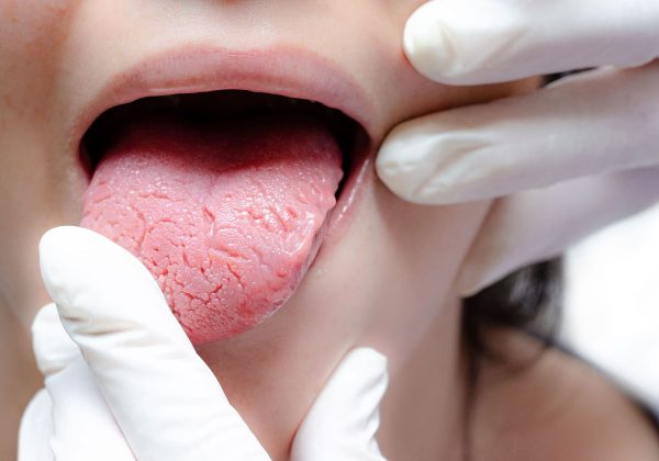 Grietas | Clínica Dental Álvarez Nóvoa